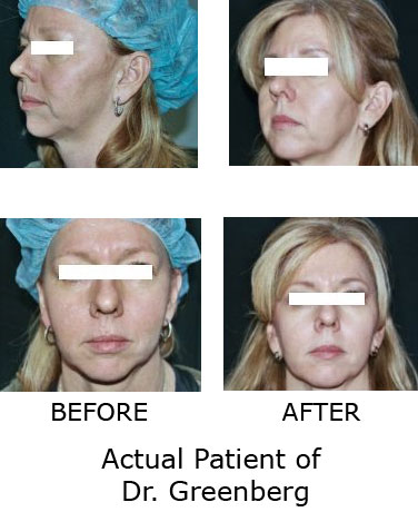 thermage before after. Before and After Photo of