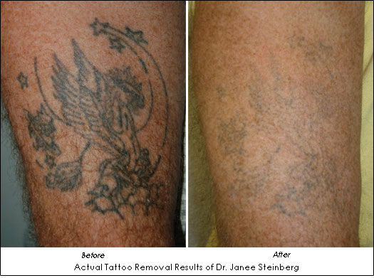 tattoo removal before and after. Laser tattoo removal results of Dr. Janee 