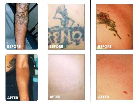 Tattoo MD Laser Clinic & MediSpaTattoo Removal