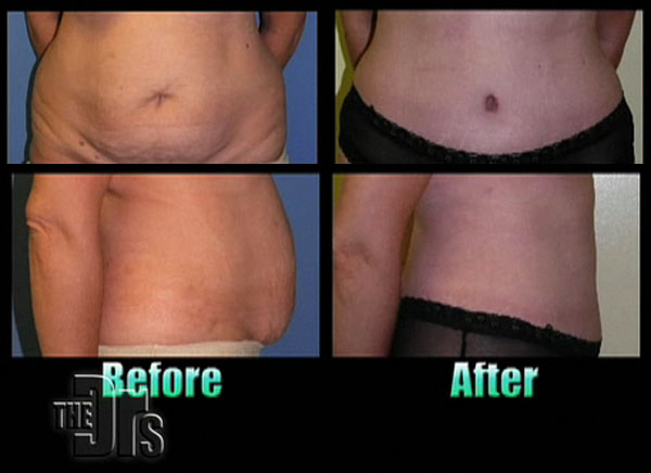 Getting Rid of Belly Fat: SmartLipo vs Tummy Tuck - AHB