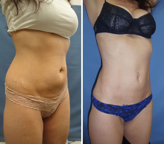 Tummy tuck with liposuction of the mons pubis, and a pubic lift