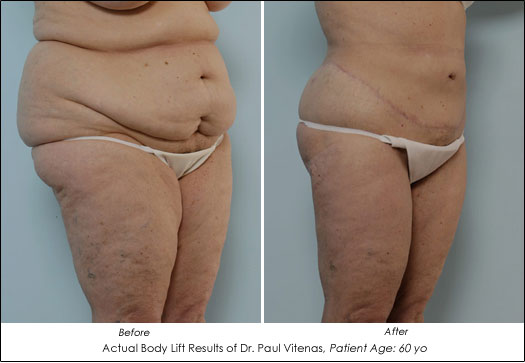 Skin After Weight Loss Surgery