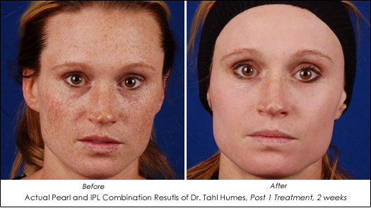 Pearl Laser and IPL Improve Skin Color and Quality - AHB