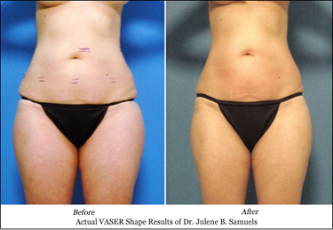 vaser shape before after