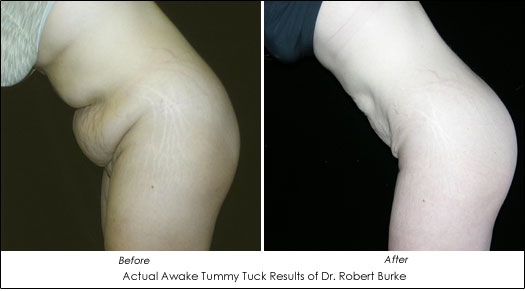 tumescent tummy tuck dr. robert burke