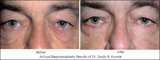 Eyelid Lift Blepharoplasty Before and After
