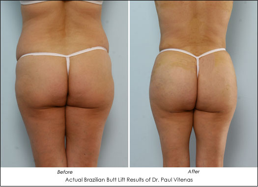 4 Ways a Brazilian Butt Lift Can Contour Your Body - Dr. Vitenas