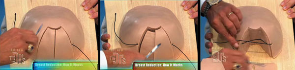 breast reduction demo on the doctors