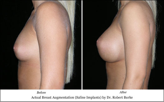 saline implant results