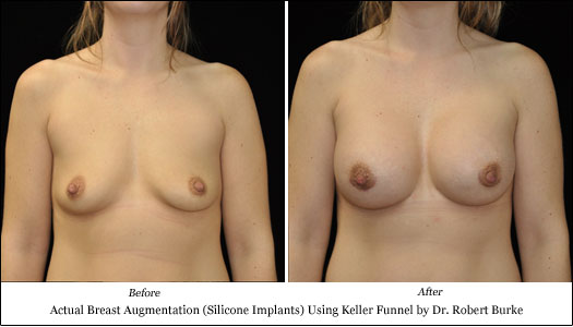 silicone breast implant results