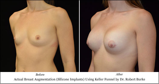 silicone implant breast augmentationresults