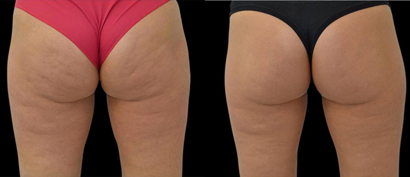 Treat Cellulite With Minimally Invasive