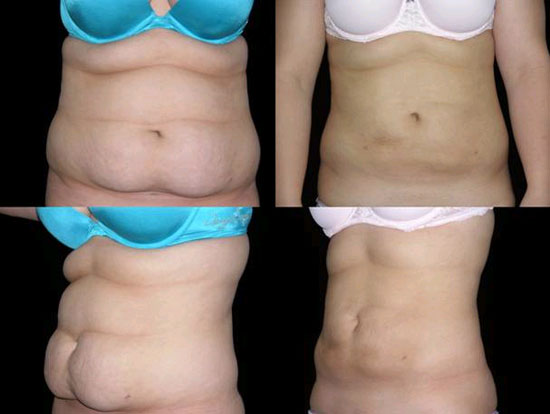 Non-Surgical Tummy Tuck Options - AHB