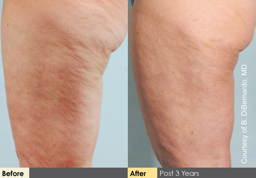 Before and After Photo of Cellulaze Results 3 Years Post-Op