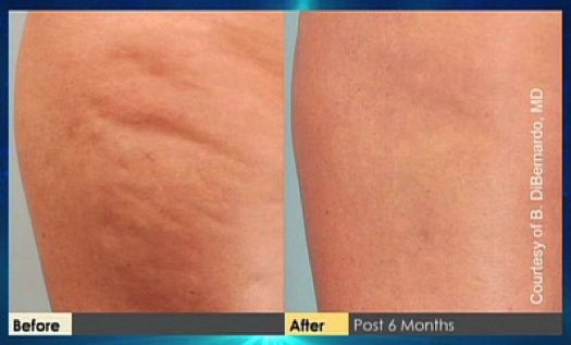 before after cellulaze results