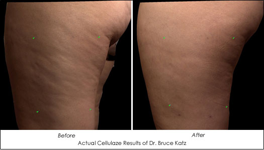 Cellulaze: The New Cellulite Treatment Laser - AHB