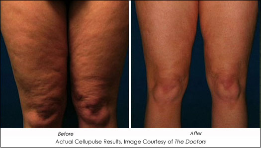 A New Wave Of Cellulite Treatments Is Here