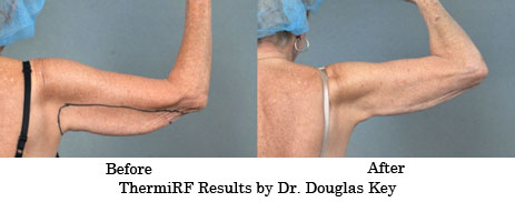 ThermiRF Before and After Results by Dr. Douglas Key