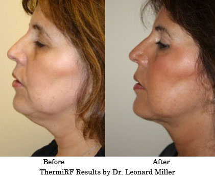 ThermiRF Before and After Results by Dr. Leonard Miller