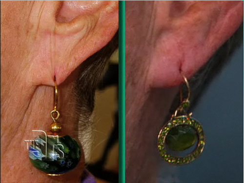 earlobe rejuvenation before and after