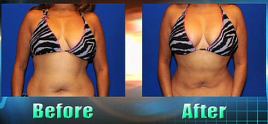 Natural Breast Augmentation Using Fat to Balance Breast Volume - AHB