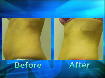 Photo of i-Lipo results