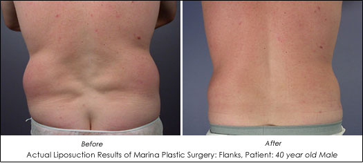 Liposuction of Back and Flanks - Associates in Plastic Surgery