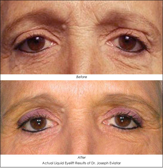 fillers before and after photos