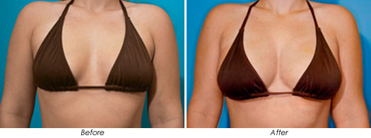 Natural Breast Augmentation Using Fat to Balance Breast Volume - AHB