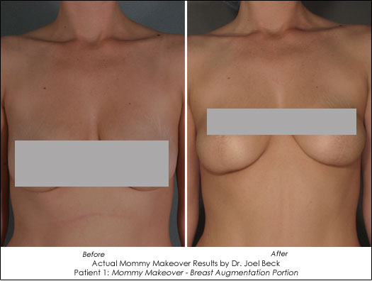 mommy makeover before and after