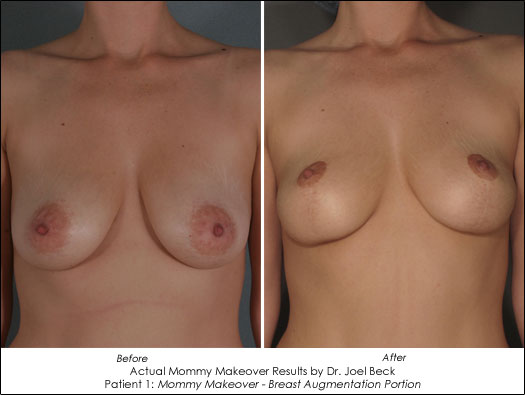 mommy makeover before and after