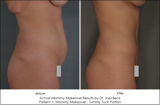 Actual Tummy Tuck results of Dr. Joel Beck