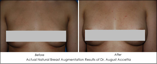 natural breast augmentation before and after