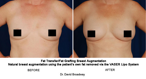 Natural Breast Augmentation Stem Cells and Fat Transfer In Lieu