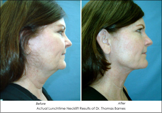 Get A Neck Lift in Just 30 Minutes with SmartLipo - AHB