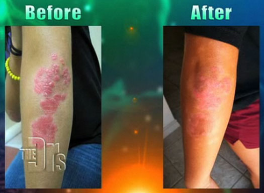 at home psoriasis light treatment