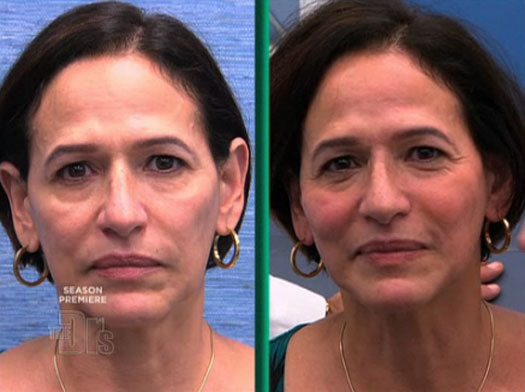 5 minute antigravity facelift