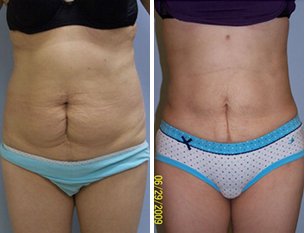 Before and After Photos of SlimLipo for Stomach