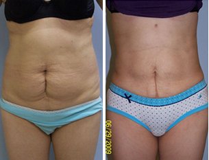 Is Laser Lipo Better Than a Tummy Tuck? - Tannan Plastic Surgery