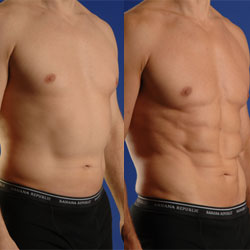 smartlipo in denver