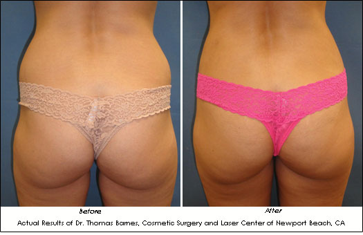 smartlipo orange county