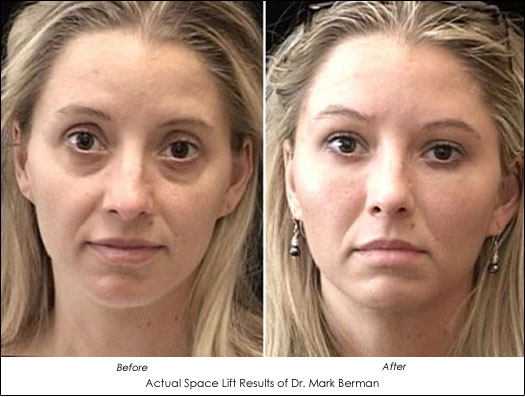 stem cell facelift before and after photos