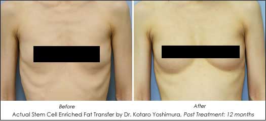 natural breast augmentation before and after