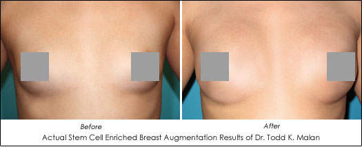 Stem Cell Breast Augmentation vs Natural Breast Augmentation - AHB