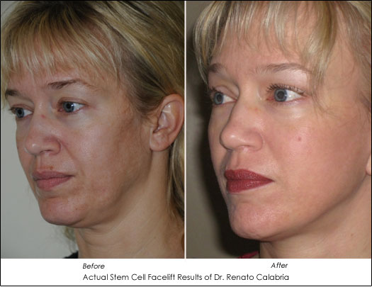 Stem Cell Face Lift Results Dr. Renato Calabria