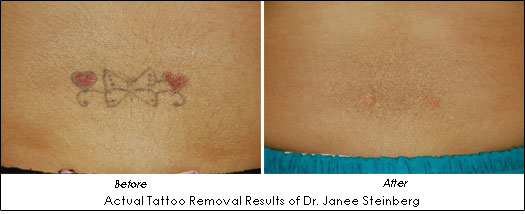 Tattoo Removal Before  After Photos Tattoo Removal Patient Results