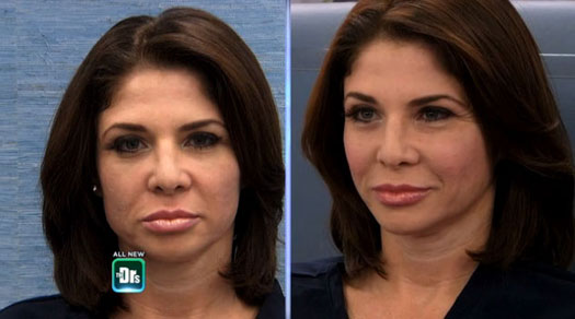 Voluma Before and After