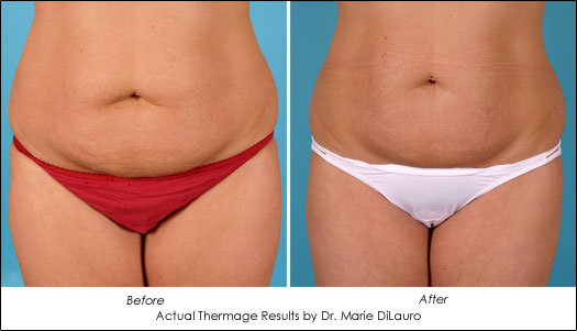 thermage body results photo