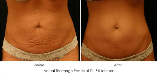 🌟THERMAGE FLX TUMMY TIGHTENING BEFORE 🆚AFTER 🌟Perfect for saggy stomach  skin.🌟 Thermage®️FLX system uses non-invasive rad