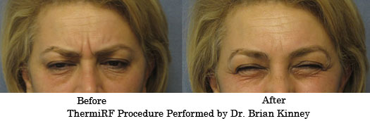 ThermiRF Before and After photo by Dr. Brian Kinney